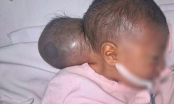 Bé gái sơ sinh 2 đầu bị bỏ rơi được các bác sỹ cưu mang và cứu sống thành công
