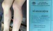 Hà Nội: Học sinh lớp 2 bị cô giáo đánh tím hai chân đến khi gãy thước vì ra chơi vào lớp muộn