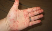 Những biểu hiện của bệnh sốt xuất huyết?