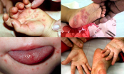 Cảnh báo: Bệnh tay chân miệng đang bùng phát ở Đắk Lắk