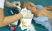 Thái Bình: Bé trai 3 tuổi bị xuất huyết não khi đi học ở trường mầm non