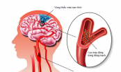 5 bài thuốc dân gian cực tốt cho người bị thiếu máu não