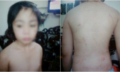 SỐC: Bé trai 10 tuổi ở Hà Nội nghi bị bố và mẹ kế bạo hành gãy xương sườn, rạn sọ não