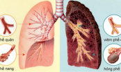 Biểu hiện bạn đã mắc ung thư phổi giai đoạn đầu: Chuyên gia nhắc dù 1 dấu hiệu nhỏ cũng không nên bỏ qua