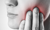 Hướng dẫn cách phòng ngừa bệnh viêm miệng