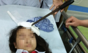 Nguy hiểm: Nam sinh lớp 7 phóng dao làm thủng đầu bạn gái cùng lớp