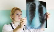 Hướng dẫn cách chăm sóc cho người bị bệnh áp-xe phổi