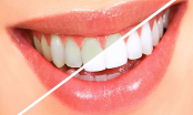 Răng xỉn vàng cũng trở nên trắng như sứ nếu sử dụng muối đúng cách