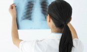 Những biểu hiện của bệnh bụi phổi atbet (amiăng)?