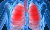 6 đối tượng dễ mắc bệnh bụi phổi silic
