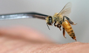 Sử dụng nọc ong trị bệnh, một người phụ nữ t.ử v.ong