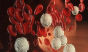 Bệnh ung thư máu ác tính có nguy hiểm không?