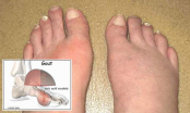 Dấu hiệu của bệnh gout