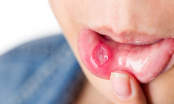 Bị nhiệt miệng có ảnh hưởng đến thai nhi không?