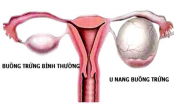 Làm thế nào để biết bạn bị buồng trứng đa nang, lạc nội mạc tử cung?