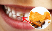 7 thực phẩm gây hại cho răng bạn nhất định phải tránh xa nếu không muốn mình bị kém duyên