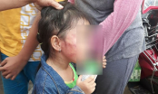 Bé gái 5 tuổi bị bảo mẫu tát đến nứt xương hàm, dọa cắt lưỡi vì nôn ói khi ăn