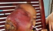 Cha mẹ thiếu hiểu biết, bé 6 tuổi mang khối u ác tính kinh khủng trên mặt vì đắp lá thuốc trôi nổi