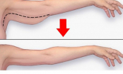 Đánh tan mỡ bắp tay vĩnh viễn nhờ 4 động tác siêu đơn giản