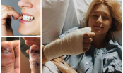 Cô gái 20 tuổi phải cắt bỏ phần ngón tay để ngăn ung thư vì thói quen nhiều người thường làm