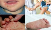 Bác sĩ cảnh báo điều phải biết về bệnh tay chân miệng, cấp độ nguy hiểm - cách chữa bệnh cho trẻ tại nhà