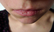 Hết sức cẩn thận nếu thấy môi thường xuyên bị khô vì đó là dấu hiệu cảnh báo căn bệnh nguy hiểm sau