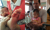 Bé gái 18 tháng tuổi bị bỏng bất thường ở chân khi đi học ở trường mầm non