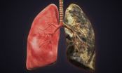 Người có thói quen này dễ mắc ung thư phổi gấp 30 lần, tránh ngay kẻo gặp tử thần sớm