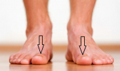 Bàn chân có dấu hiệu này đi khám ngay vì thận của bạn đang kêu cứu