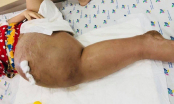 Bé 8 tuổi bị ung thư xương: Do cha mẹ thờ ơ khi con kêu đau mỏi tay chân