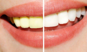 Tuyệt chiêu giúp bạn có hàm răng trắng sáng nhanh chóng