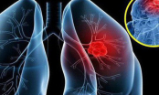 Người phụ nữ 58 tuổi bị ung thư phổi vẫn sống khỏe gần chục năm nhờ phương pháp vô cùng đặc biệt