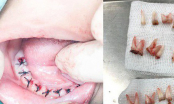 Cảnh báo sau vụ: Cậu bé 4t mất đi toàn bộ 18 chiếc răng vì thói quen lặp đi lặp lại của bố mẹ