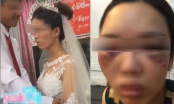 Sự thật ngã ngửa bức ảnh cô dâu bị đánh thâm tím mặt mày vì từ chối hôn chú rể trong đám cưới