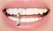 Răng trắng bóc sau khi tẩy bằng baking soda nhưng lợi bất cập hại