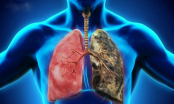 6 việc giúp giải phóng phổi khỏi bệnh tật, ung thư, người còn khoẻ phải làm ngay kẻo mang hoạ