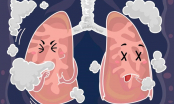 5 dấu hiệu cảnh báo phổi có vấn đề, nguy hiểm khó lường, hãy nhanh đi gặp bác sĩ ngay còn kịp