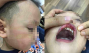 Xôn xao bé trai 3 tuổi bị cô giáo bế ra góc khuất camera đánh bầm dập, tụ máu miệng