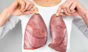 Phổi chứa đầy độc tố: 4 việc cần làm ngay nếu muốn phổi khoẻ mạnh, lọc sạch bay mọi chất độc