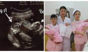 Bắt gặp sản phụ sinh 2 con cùng lúc nhưng bác sĩ lại nói đây không phải là cặp song sinh