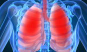 8 dấu hiệu cảnh báo ung thư phổi mà rất nhiều người vẫn bỏ qua