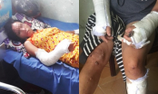 Vợ mang bầu 7 tháng bị chồng đánh đập đến gãy tay chân, vỡ nền sọ