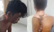 Nam thanh niên bị chị ruột đổ nước sôi lên đầu gây bỏng nặng: Hé lộ nguyên nhân bất ngờ