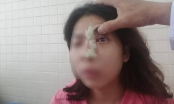 Tiêm filler nâng mũi ở spa gần nhà, cô gái trẻ bị mù mắt trái