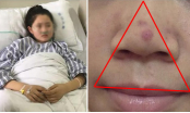 Cảnh báo từ vụ: Bé 12 tuổi nguy kịch vì nặn mụn ở mũi, lưu ý vùng tam giác nguy hiểm trên mặt