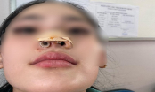 Chi tiền đi làm đẹp, cô gái 16 tuổi bị nhiễm trùng, biến dạng phần đầu mũi