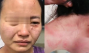 Nữ y tá bị bệnh nhân nhiễm Covid-19 đánh đập, cắn rách mặt