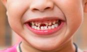 5 món ăn vặt hấp dẫn nhưng nằm trong danh sách đen, ảnh hưởng đến men răng của trẻ