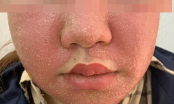 Đắp mặt nạ làm trắng da giá 600.000 đồng mua trên mạng, cô gái nhập viện với gương mặt chi chít mụn mủ