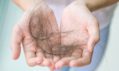 Rụng nhiều tóc là dấu hiệu của bệnh gì?